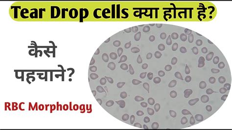 tear drops blood test|blood tear drop cells pictures.